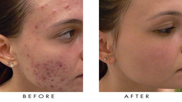 como eliminar cicatrices de acne profundas