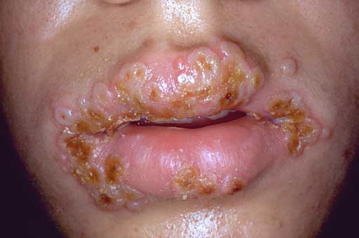 about herpes on the lip.