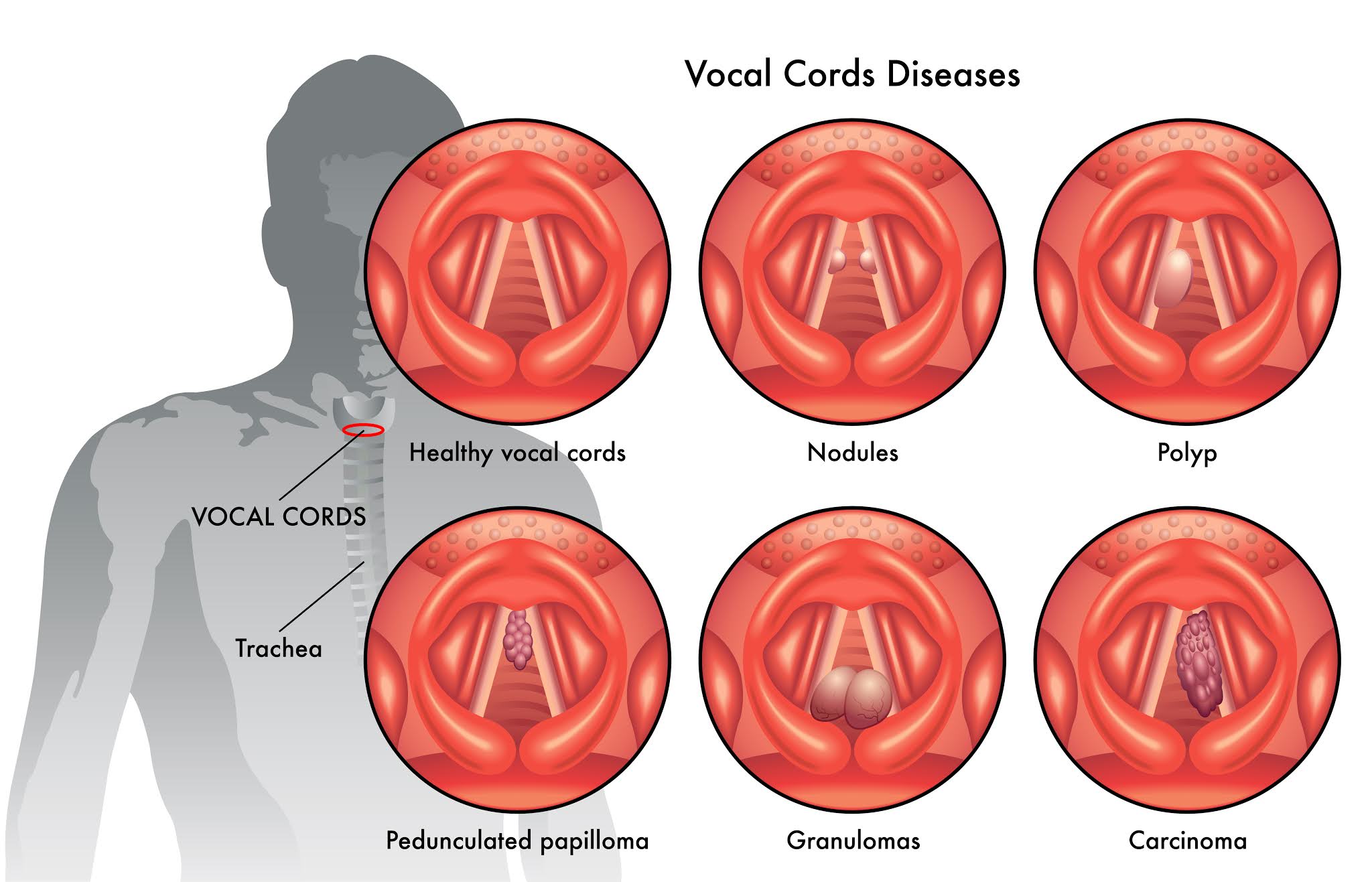 一般聲帶病灶：包含結節/長繭(Nodule)、息肉(Polyps)、囊腫(Cyst)、纖維腫(Fibrous Mass)、反應性腫(Reactive)、非特異性腫(Nonspecific)、偽囊腫(Pseudocyst)等等。