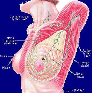 breast cancer