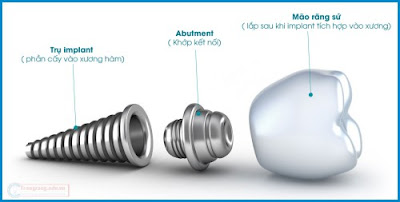 Địa chỉ cấy ghép implant chi phí thấp