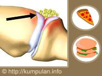  asam urat disebabkan oleh ketidakmampuan ginjal membuang asam urat