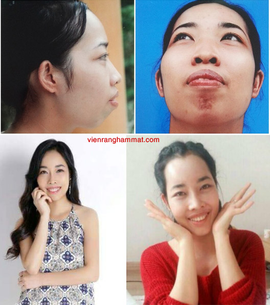 Cô gái Phú Thọ lột xác sau khi phẫu thuật hàm hô - Trước và sau