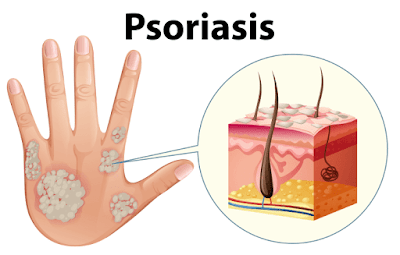 Best psoriasis cure in ayurveda nagpur