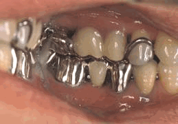 Akers' clasp (Dental Equipment)
