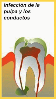<Img src ="Secuencia_endodoncia.gif" width = "416 height "723" border = "0" alt = "Pasos a seguir en una endodoncia.">