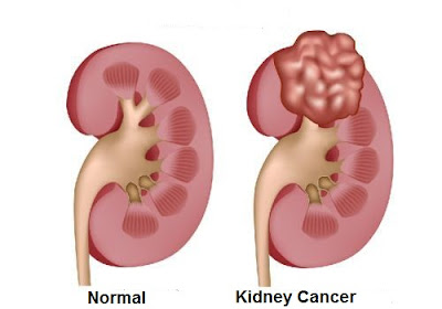 kidney cancer: causes, symptoms, diagnosis and treatment