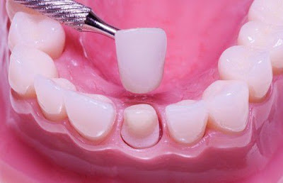  Bọc răng sứ cho răng hàm khi nào?