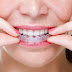 Tìm hiểu về phương pháp niềng răng 3D Clear