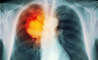 Scientists In Amsterdam Just Destroyed Breast Cancer Tumors In 11 Days Without Chemotherapy