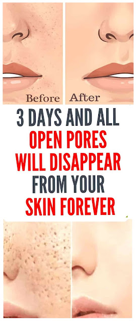 3 Days and All Open Pores Will Disappear From Your Skin Forever By Using These Homemade Solutions