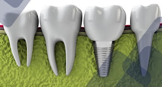 Cấy ghép răng implant giá bao nhiêu-1