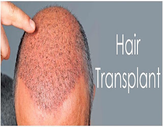 Best Hair Transplant Clinic In Mumbai  