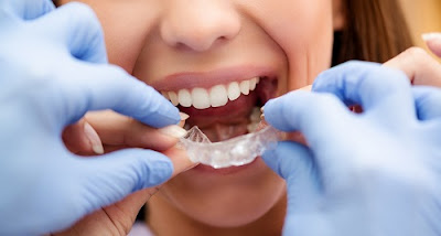 Hỏi để biết mất răng hàm có niềng răng được không 2