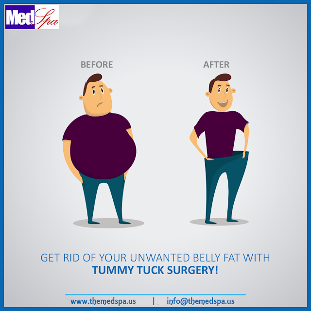 tummy-tuck-abdominoplasty-surgery