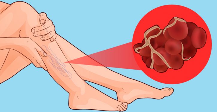 8 Signs That You Have A Blood Clot That Can Cause An Infarction Or Stroke