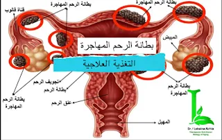 ماهي اساسيات التغذية العلاجية لمرض بطانة الرحم المهاجرة Endometriosis د. لبينة الرحية