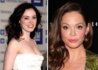 Kegagalan Operasi Plastik Rose McGowan