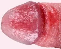 Itching of the penis