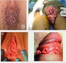 Jual Obat Atasi Daging Tumbuh Di Kelamin 