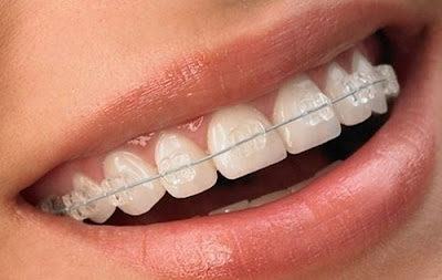 Niềng răng mắc cài sứ có ưu điểm gì?