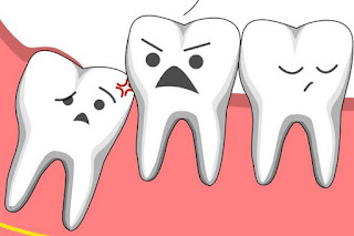 Nhổ răng số 8 có nguy hiểm không-1