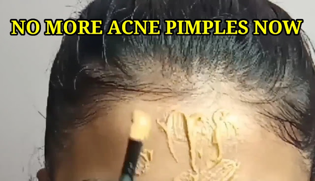 no more acne pimples