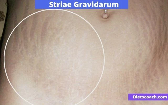 Striae Gravidarum