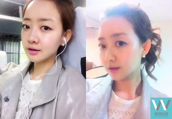 짱이뻐! - Yahoo! Fully Recovered After Plastic Surgery in South Korea! 