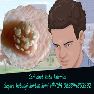 Obat kutil kelamin