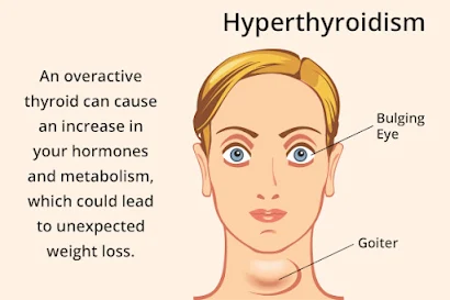 hyperthyrodism causes weight loss
