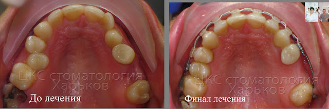 Зубы до лечения и в финале ношения брекетов