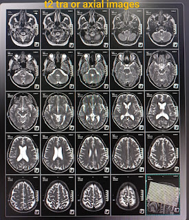 MRI of brain with contrast film