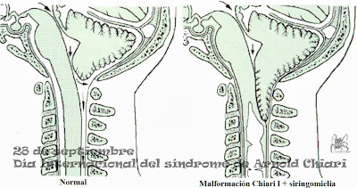 el 28 de septiembre es el día internacional del sindrome de Arnold Chiari