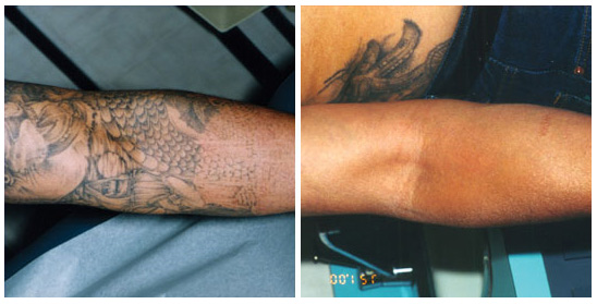 Tattoo Removal Before And After