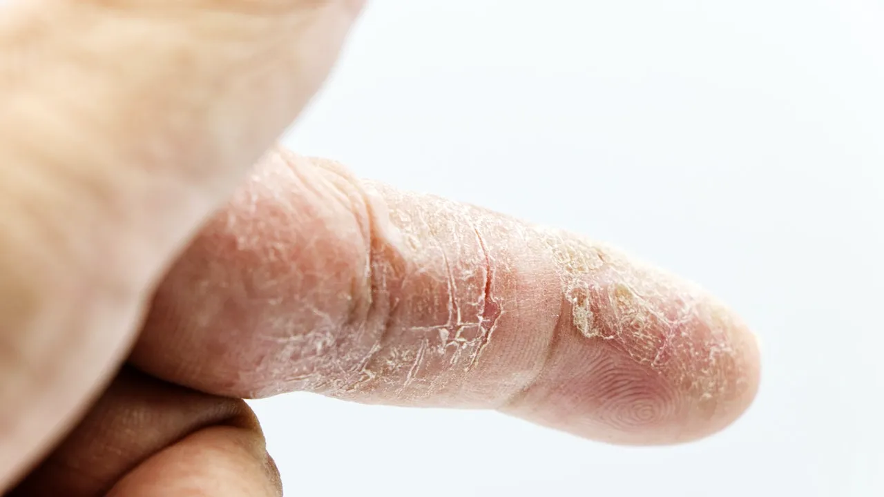piel seca a causa del minoxidil