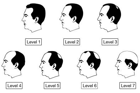 Hair Loss Treatment for Men । Result । The Bold head Steps । Health n Beauty HuB