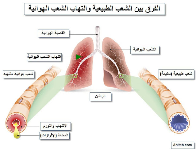 الفرق بين الشعب الهوائية الطبيعية والنزلة الشعبية