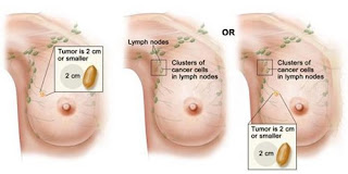 berita pengobatan alternatif kanker payudara, mengobati kanker payudara yang pecah, cara mengobati kanker payudara secara alami, herbal untuk tumor dan kanker payudara, kanker payudara menular tidak, kanker payudara yaitu, herbal penyakit kanker payudara, gejala awal kanker dan tumor payudara, penyebab kanker payudara laki-laki, kanker payudara stadium 2b, obat herbal kanker tumor payudara, obat alami cegah kanker payudara, obat kanker payudarah, kanker payudara terminal, ramuan herbal pencegah kanker payudara, obat penyakit kanker payudara stadium 4, cara mengobati kanker payudara yg sudah pecah, mengobati kanker payudara yang pecah, obat kanker payudara tianshi, tingkat kesembuhan kanker payudara stadium 3, obat kanker payudara adalah, prognosis kanker payudara stadium 4, kanker payudara cara mendeteksi, mengobati kangker payudara secara tradisional, penyakit kanker payudara stadium 2, cara pengobatan kanker payudara dengan propolis, obat kanker payudara alami