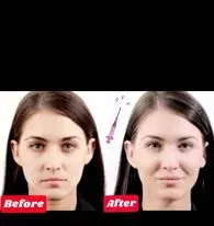 Cheek Fillers before and after| Achieve your desire look