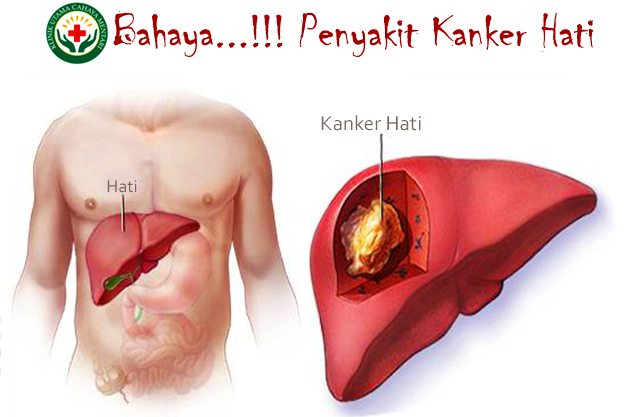 Dokter Kanker Hati Terbaik Di Indonesia