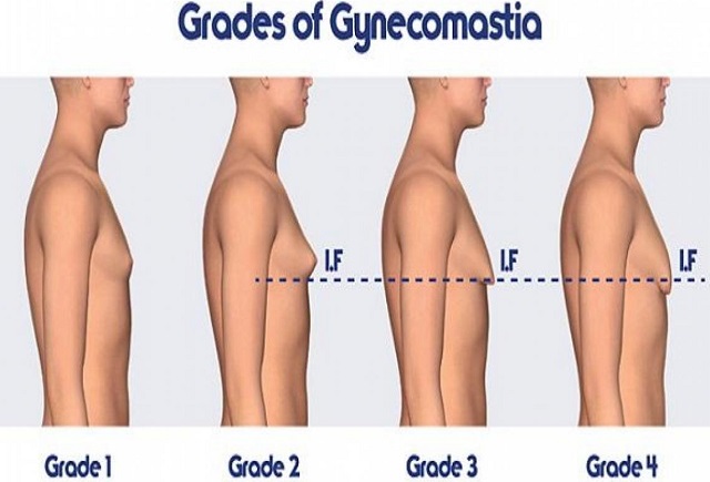 how to detect gynecomastia man boobs male breast tissue