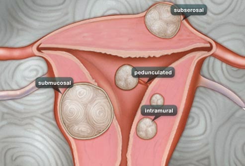 Apa Itu Fibroid Dan Supplement Shaklee Yang Bersesuaian Celoteh Ummi