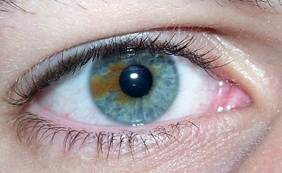 Variasi dari kondisi Heterochromia ini adalah dimana seseorang memiliki variasi beberapa warna pada mata