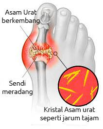 Obat Asam Urat