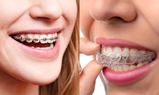 Niềng răng clear aligner - những bước đột phá mới