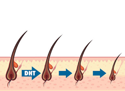 DHT – thủ phạm gây ra bệnh rụng tóc, hói đầu 