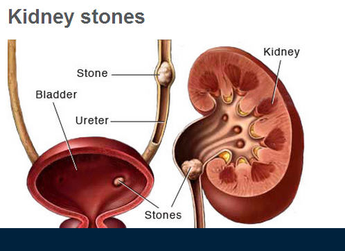 Kidney-Stone