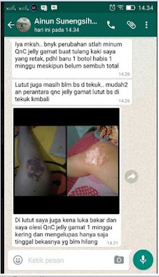 Salep Penghilang Bekas Luka Bakar Di Wajah 