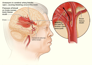 pengobatan herbal stroke